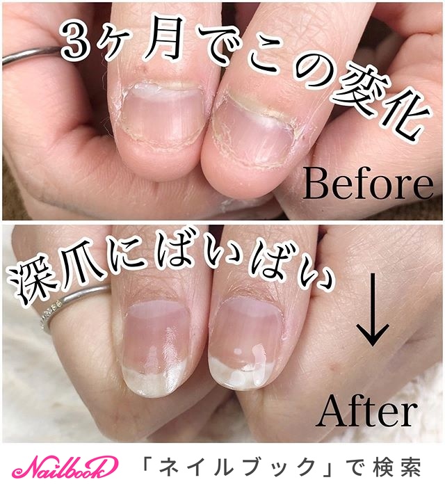足利深爪矯正のネイルデザイン ネイルブック