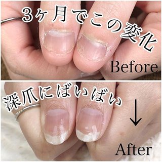 太田深爪矯正のネイルデザイン ネイルブック