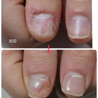 足の深爪矯正のネイルデザイン ネイルブック