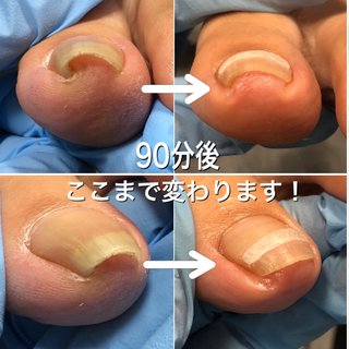 巻き爪矯正と巻き爪ケアの違いのネイルデザイン ネイルブック