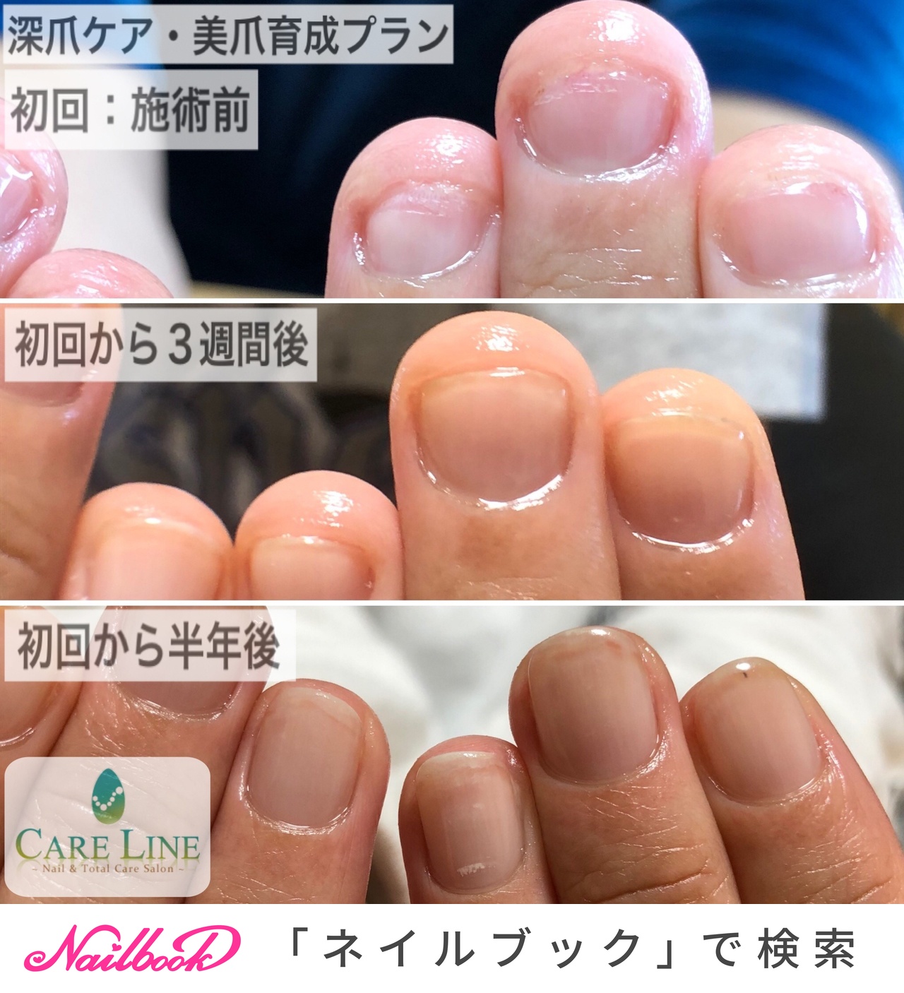 ハンド お客様 ケアライン 熊谷 深爪緩和 美爪育成 巻き爪ケアのネイルデザイン No ネイルブック