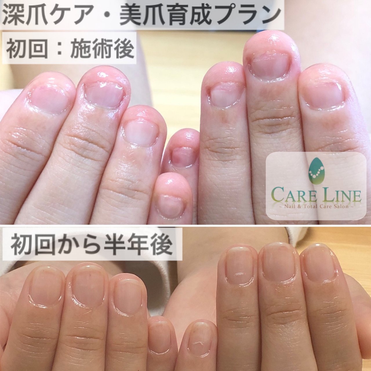 ケアライン 熊谷 深爪緩和 美爪育成 巻き爪ケアのネイルデザイン No ネイルブック
