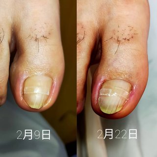 人気順 爪水虫のネイルデザイン ネイルブック