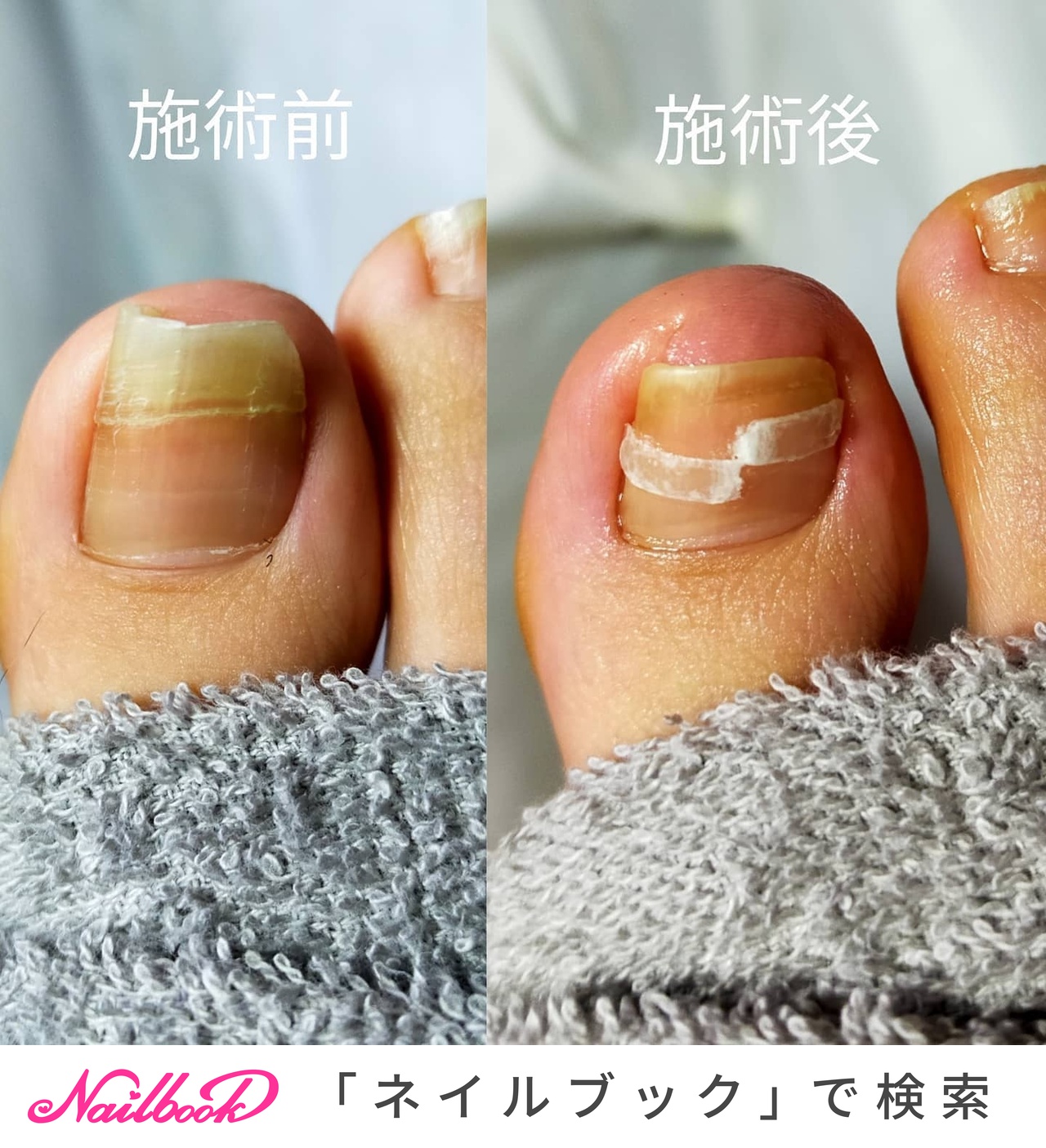 爪水虫のネイルデザイン ネイルブック