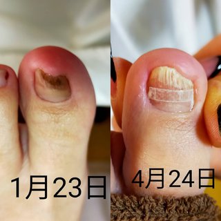 爪水虫のネイルデザイン ネイルブック