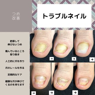 汚い足の爪のネイルデザイン ネイルブック