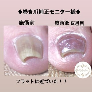 ネイルサロンで巻き爪補正のネイルデザイン ネイルブック