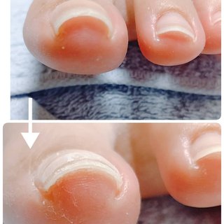 巻き爪の痛みを緩和したいのネイルデザイン ネイルブック