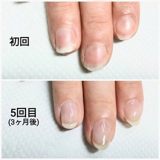 爪甲剥離症のネイルデザイン ネイルブック