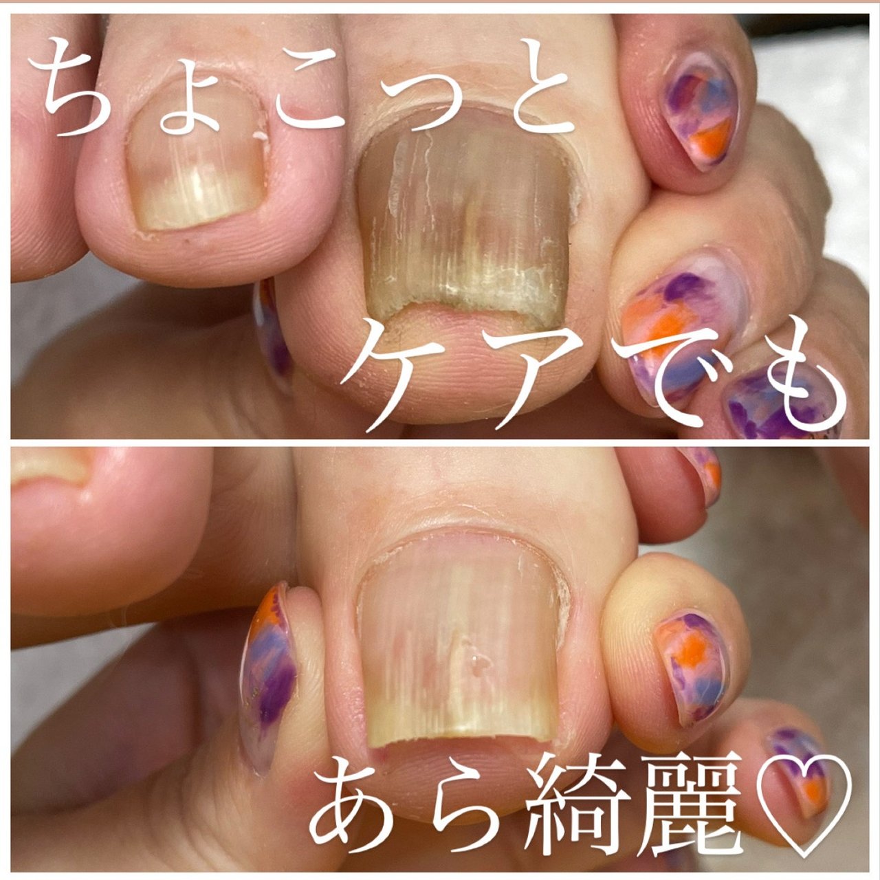 ニャムネイル 自爪育成 巻き爪ケア トラブルネイル対応サロン やざわみゆきのネイルデザイン No ネイルブック