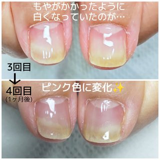 爪甲剥離症のネイルデザイン ネイルブック