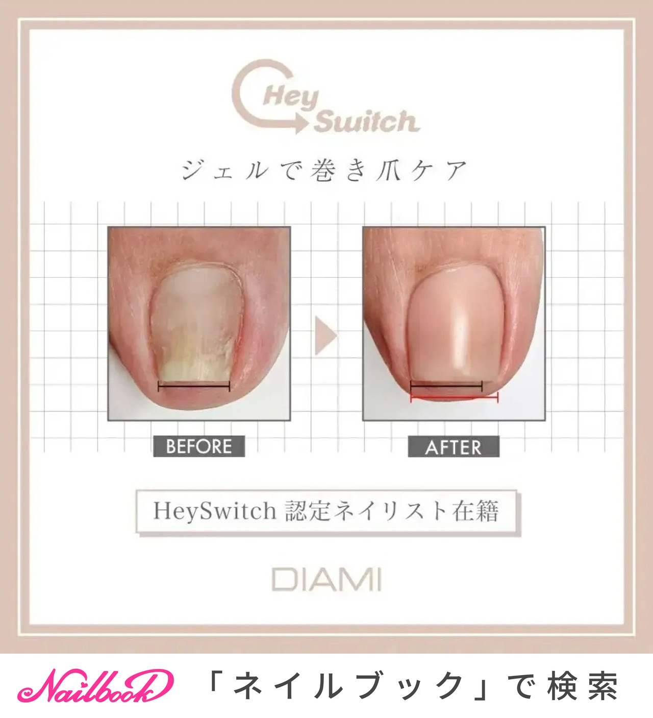 heyswitch ヘイスイッチ ベース／クリア／トップ3点セット　巻き爪 巻き爪でお困りの方必見！ - BILLBOARD PLACE 新潟ファッションビル