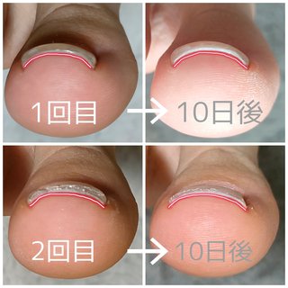 ヘイスイッチ　Heyswitch 新品未使用　巻き爪ケア　ベース＆トップ　正規品 ◇革命◇新世代巻き爪ケア Hey Switch ｜ 巻き爪にお悩みなら