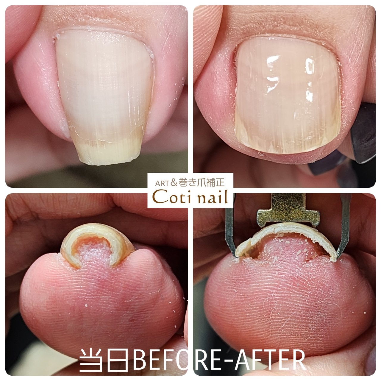 夏/秋/オールシーズン/女子会/フット - コチネイル.えり◐巻き爪