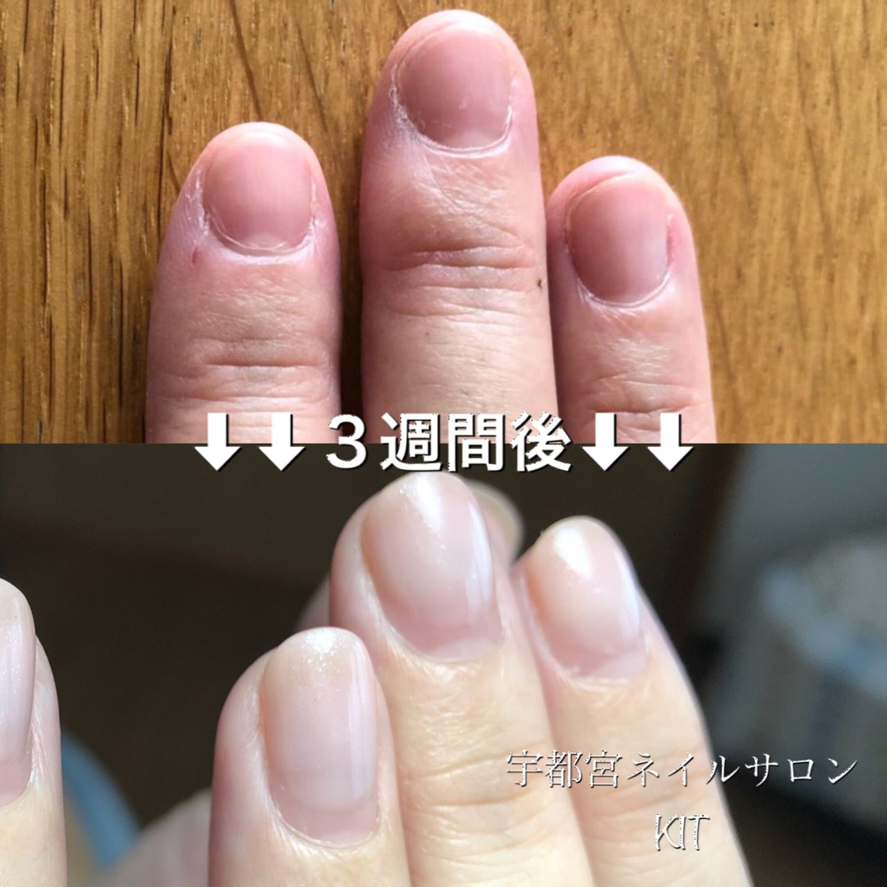 ハンド ジェルネイル お客様 宇都宮市 深爪専門 ネイルサロン キットのネイルデザイン No ネイルブック