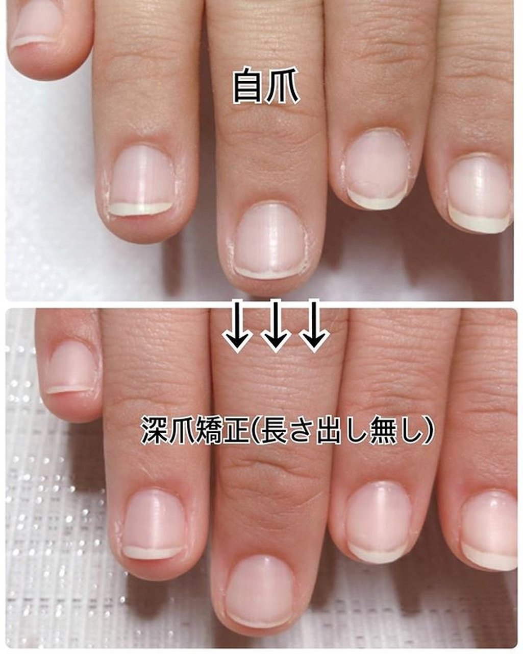 オールシーズン ハンド Smile Nico 深爪矯正のネイルデザイン No ネイルブック