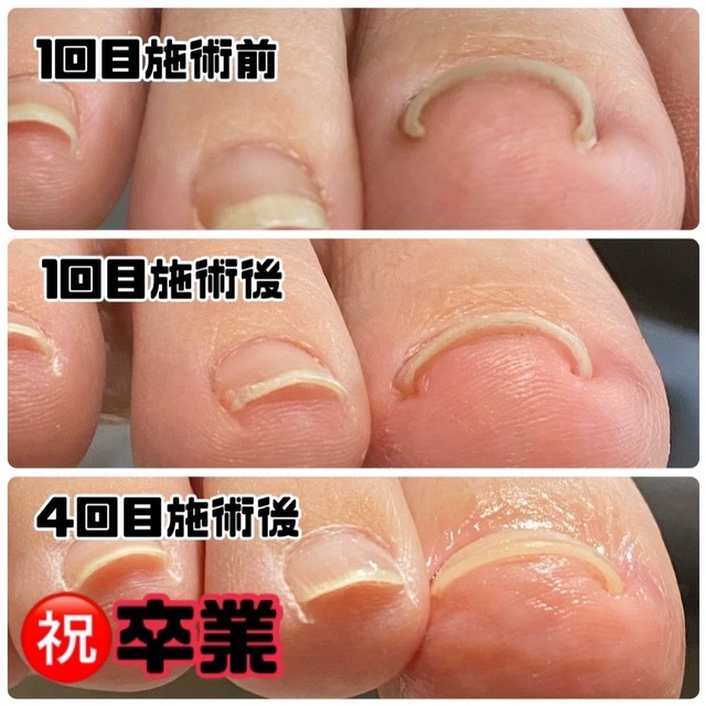 爪のトラブル駆け込み所💪✨ 「Nailsalon raRa」｜多治見のネイル