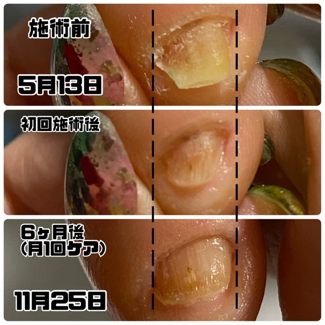 爪のトラブル駆け込み所💪✨ 「Nailsalon raRa」｜多治見のネイル