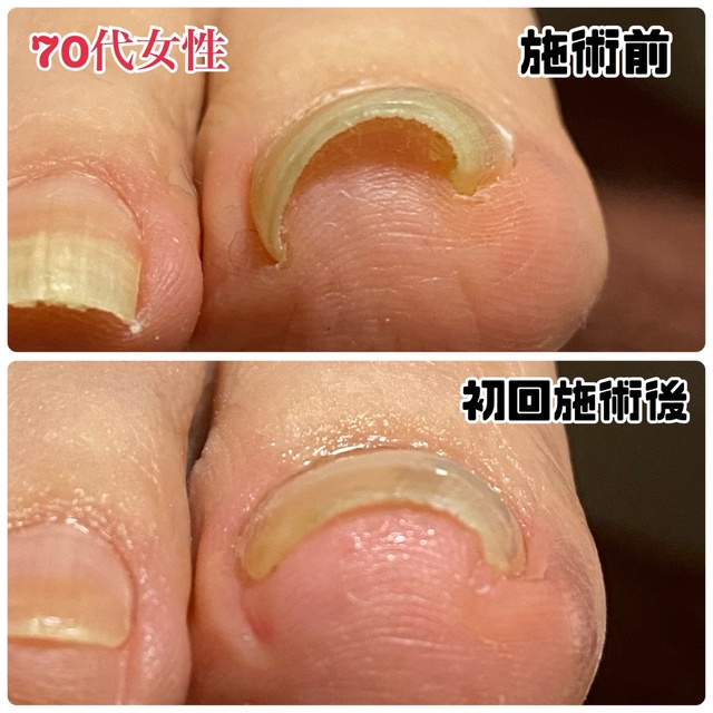 爪のトラブル駆け込み所💪✨ 「Nailsalon raRa」｜多治見のネイル