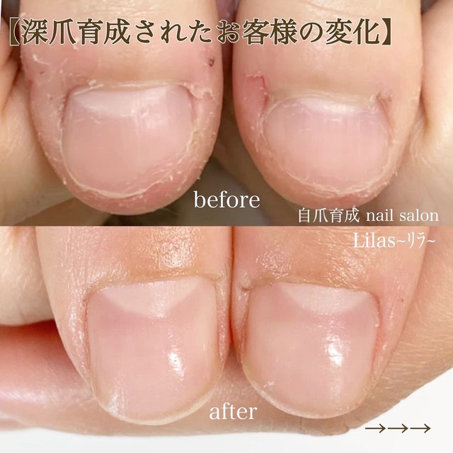 深谷市 深爪育成 / 自爪育成 nail salon Lilas ~ﾘﾗ~｜岡部のネイル