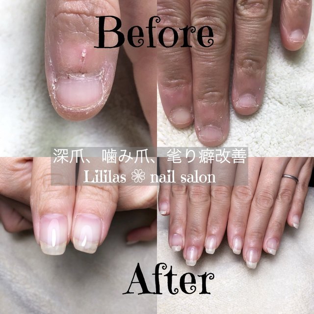 Lililas Nail Salon School お爪のトラブルケア 整形級ネイル 甚目寺のネイルサロン ネイルブック